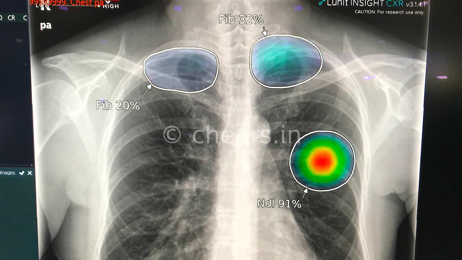The Transformative Evolution of Artificial Intelligence in Healthcare